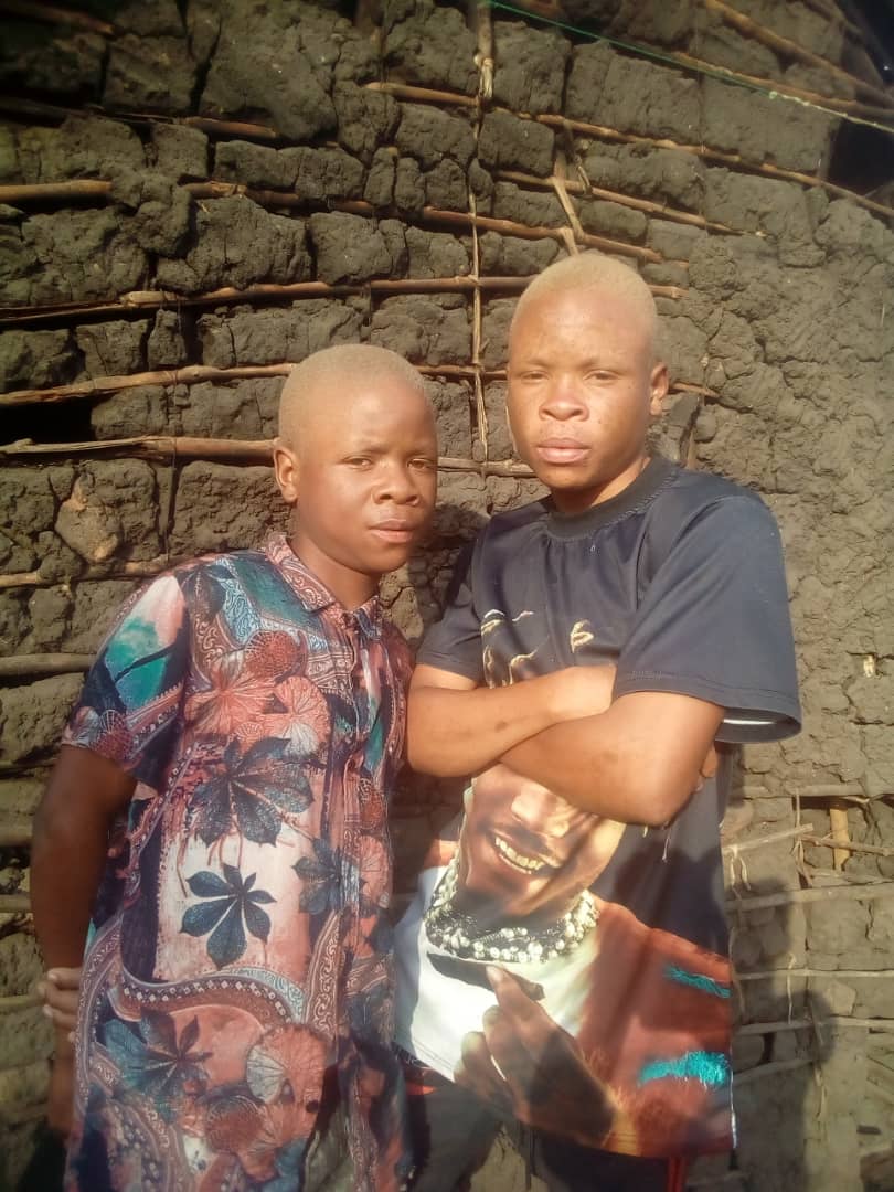Beyond the Skin; Ensuring Inclusive Education and Dignity for Persons with Albinism