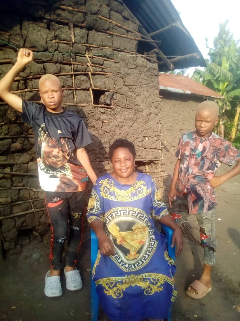 Albinos in Kasese Advocate for Acceptance and Fight Against Misconceptions